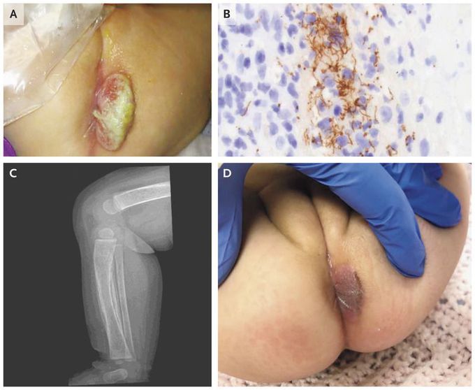 Congenital Syphilis
