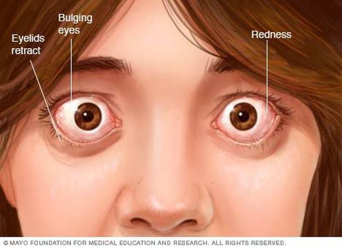 Graves ophthalmopathy