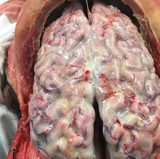 MENINGITIS