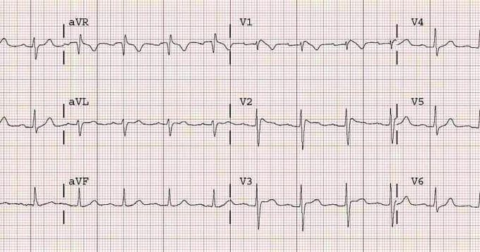 Brugada syndrome 