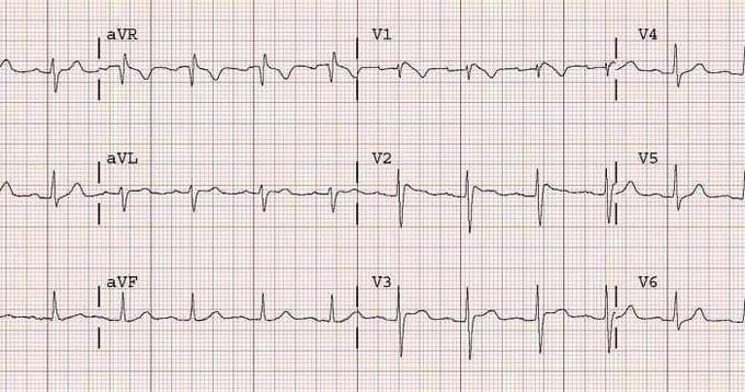 Brugada syndrome - MEDizzy