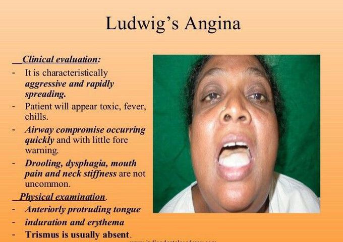 Symptom of Ludwig Angina