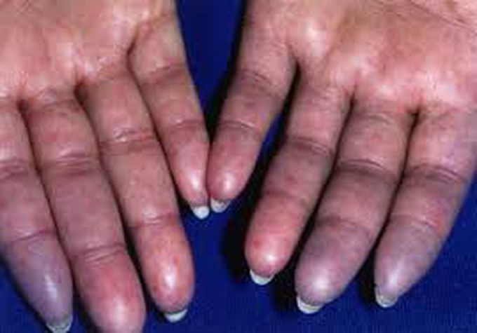 causes of scleroderma