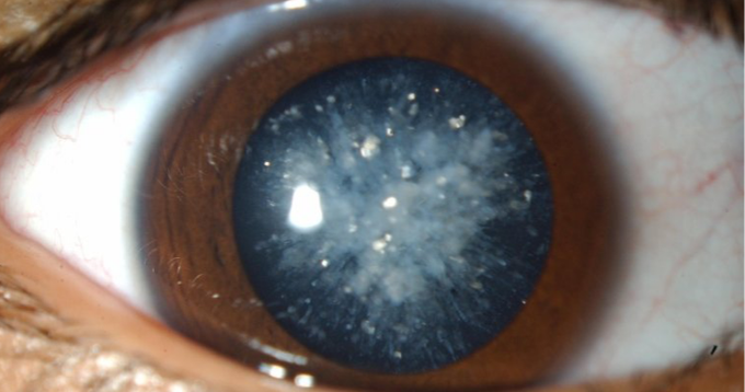 Cataract