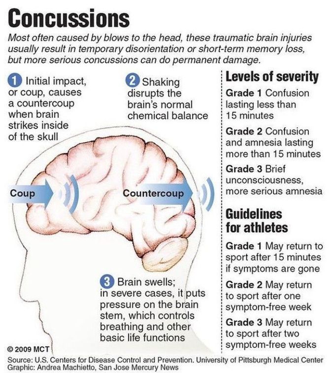 Concussions