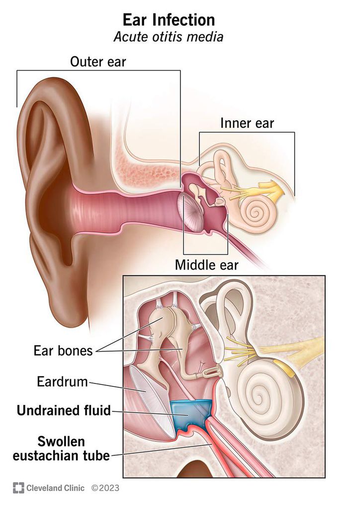 Risk factors for otitis media