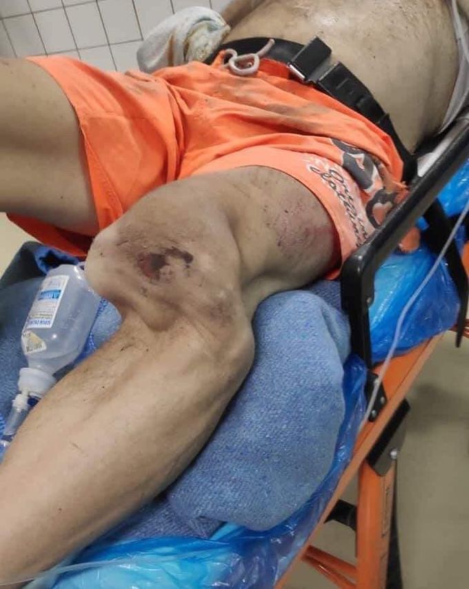 Bike accident resulting in severe knee dislocation ⚠️ 