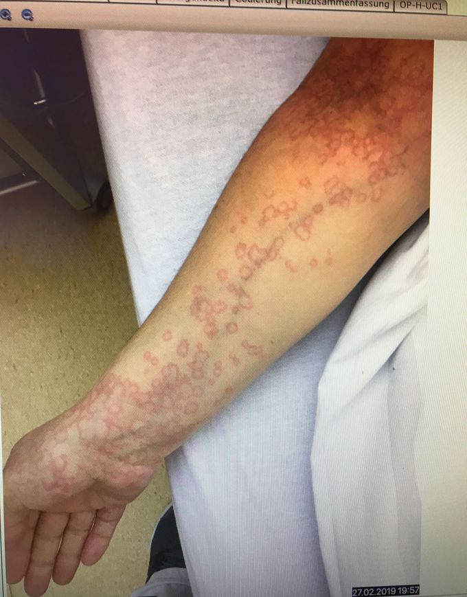 Allergic