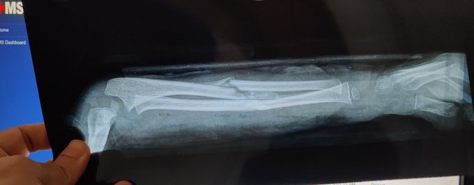 Fracture Radius+Ulna