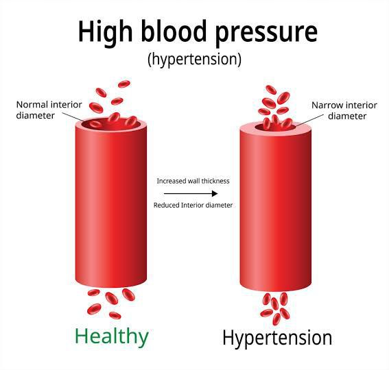 How to diagnose hypertension - MEDizzy