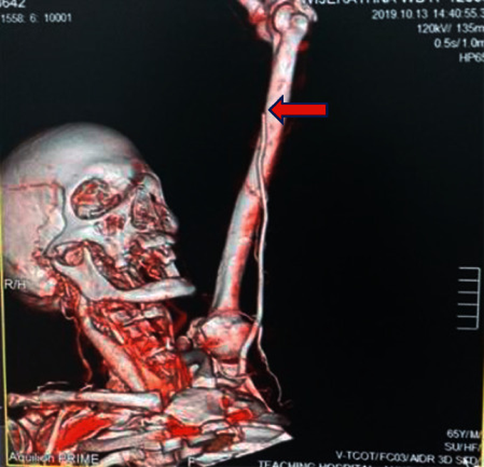 Brachial Artery Thrombosis caused by Multiple Wasp Bites