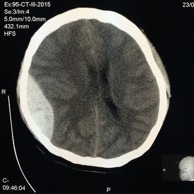 Epidural hematoma