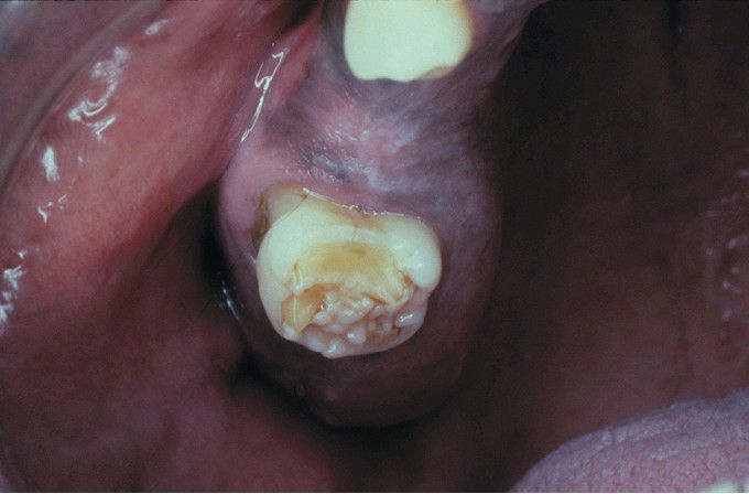 Mulberry Molar of Congenital Syphilis.