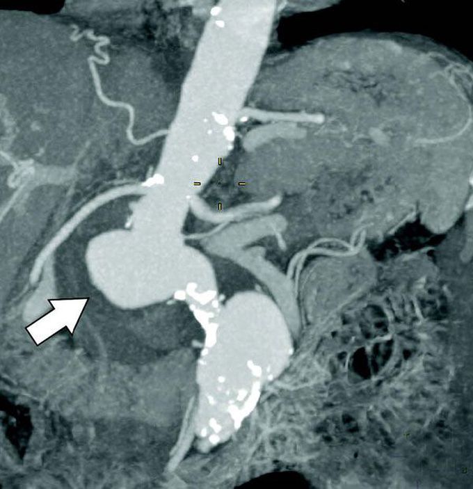 Abdominal aortitis