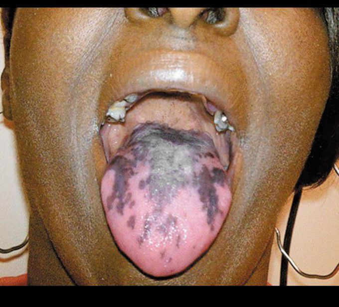 Drugs and dyspigmentation