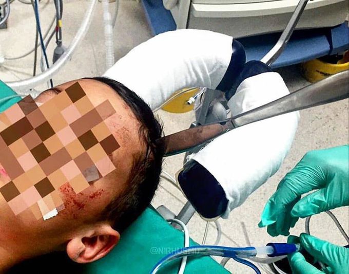 Butter knife stuck in the patients head!