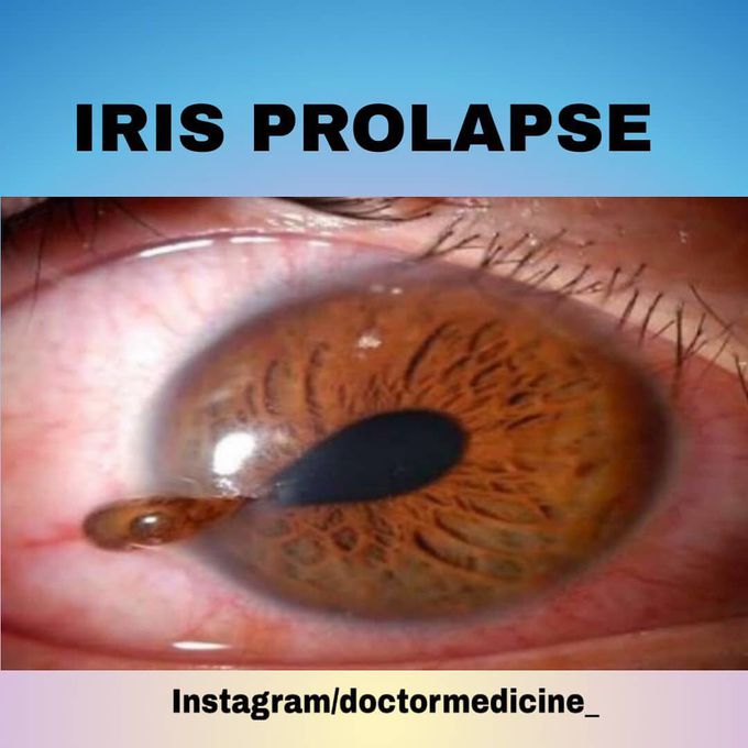 What Is Floppy Iris Syndrome?