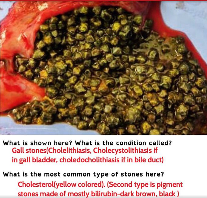Gallstones Aka cholelithiasis