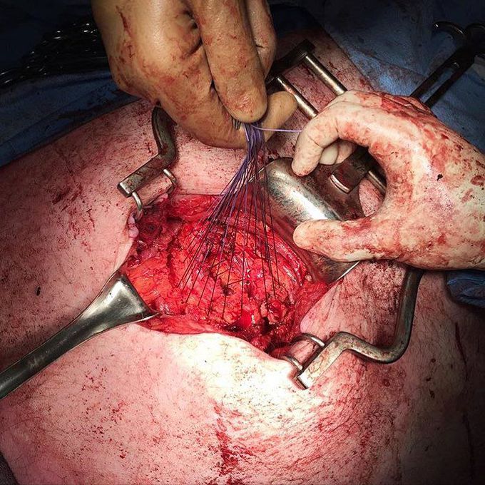 Open repair of an incisional hernia