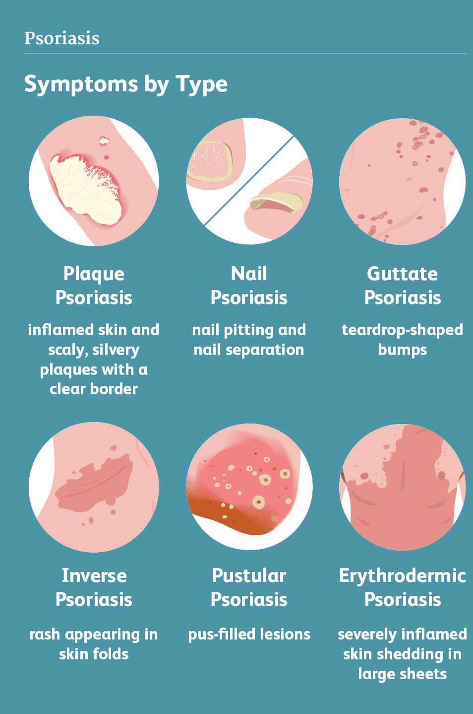 Symptoms of Psoriasis - MEDizzy