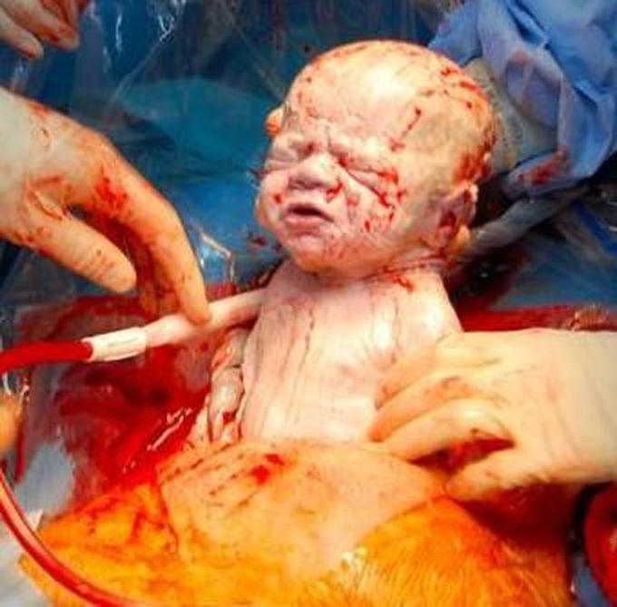 What are the indications of Cesserian section? 