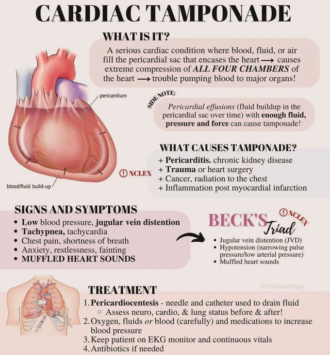 Cardiac Tamponade