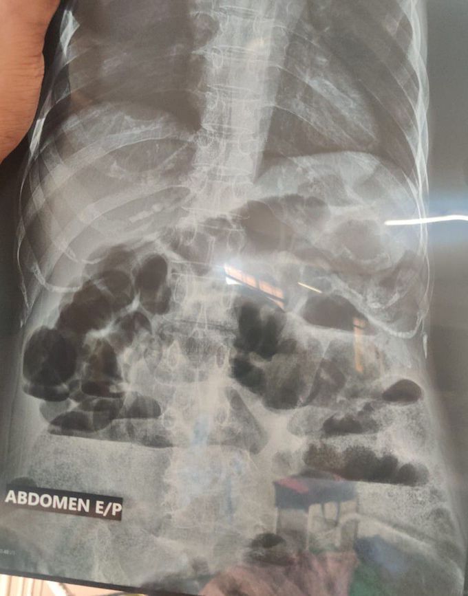 A case of Intestinal obstruction due to abdominal tuberculosis.