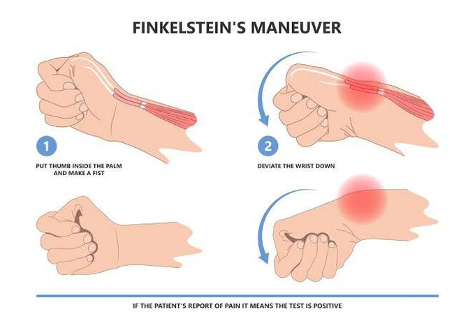 Finkelstein's Maneuver