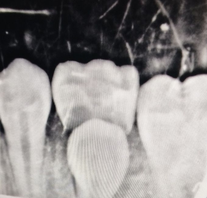 Identify the Erupting Tooth