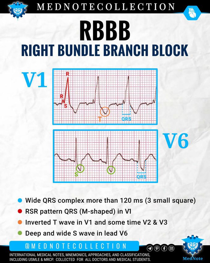 RIGHT BUNDLE BRANCH BLOCK