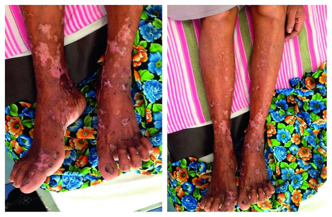 Eosinophilic Granulomatosis with Polyangiitis in 49-Year-Old