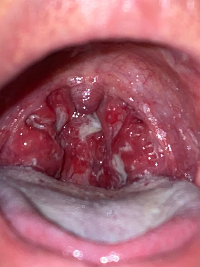 Chronic Tonsilopharyngitis acute phase