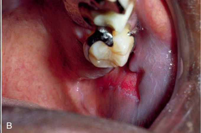 Discoid lupus erythmatosus