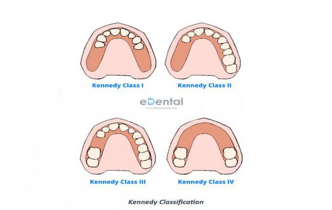 Kennedy classification