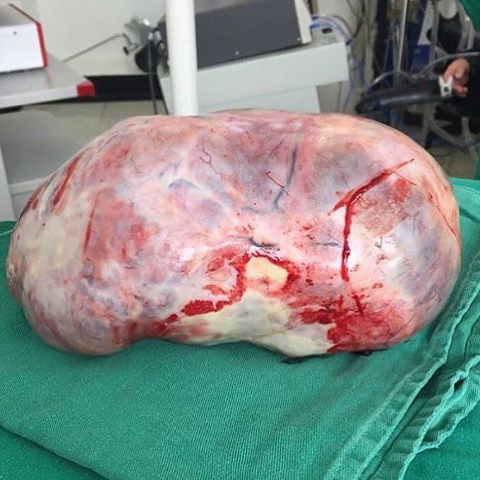 Tumour