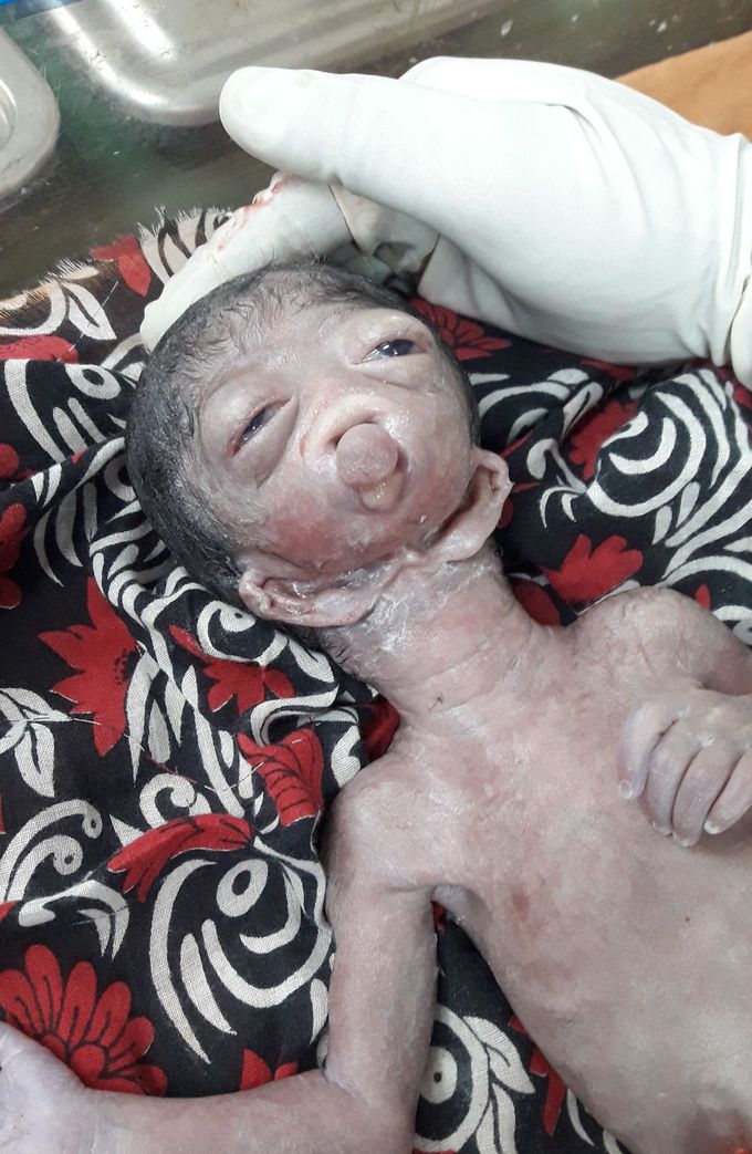 Unknown congenital anomaly