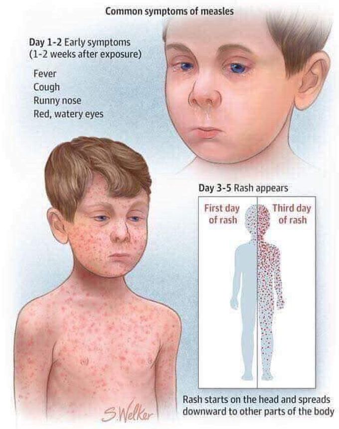 Measles