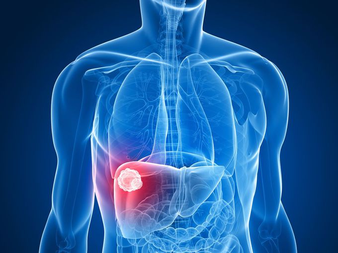 Liver lesions