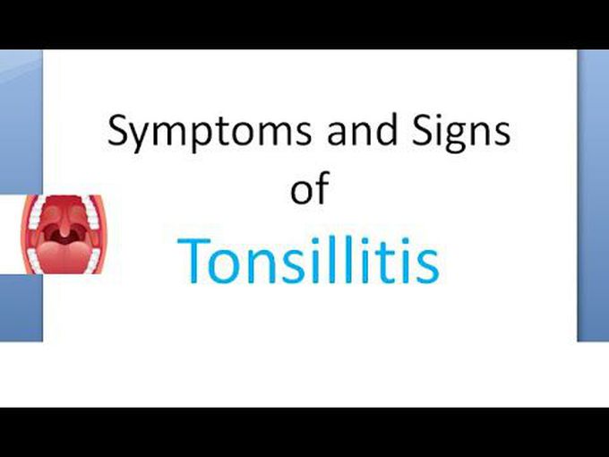 Acute and Chronic Tonsillitis