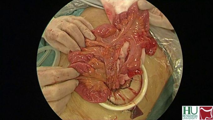 Redo Pouch & Re-stapled Anastomosis after Fluorescence Angiography Detection of Pouch Ischemia