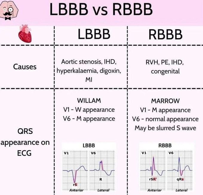 LBBB Vs RBBB