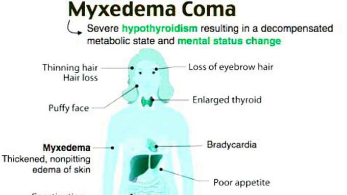 Myxedema Coma - A Medical Emergency! - MEDizzy