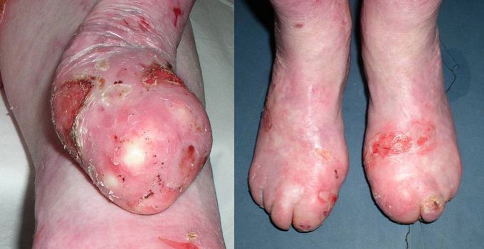 Recessive dystrophic epidermolysis bullosa (RDEB)
