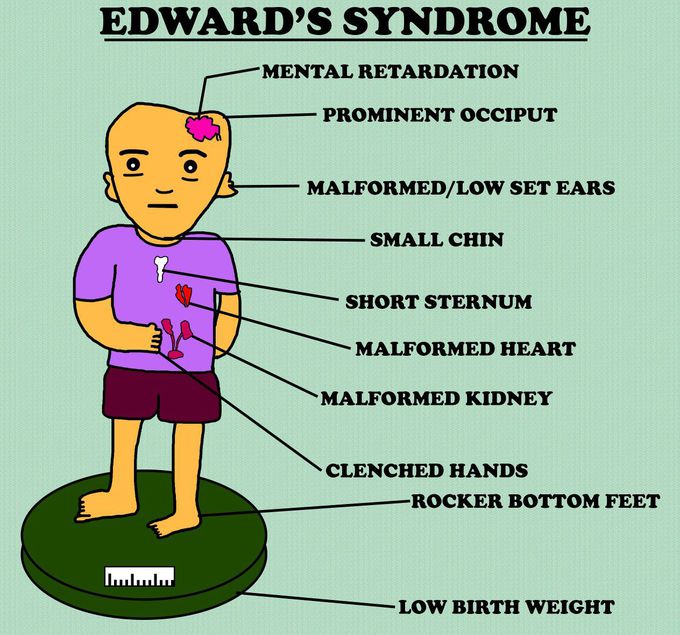 Edwards syndrome