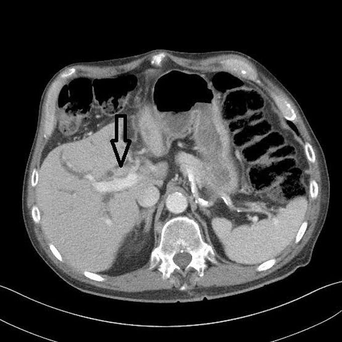 Klatskin Tumor AKA Hilar Cholangicarcinoma