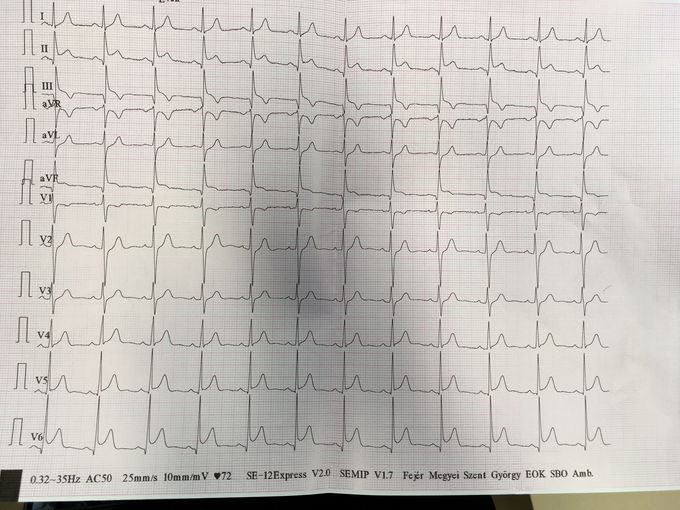 Anyone have a tip for the Troponin levels?
