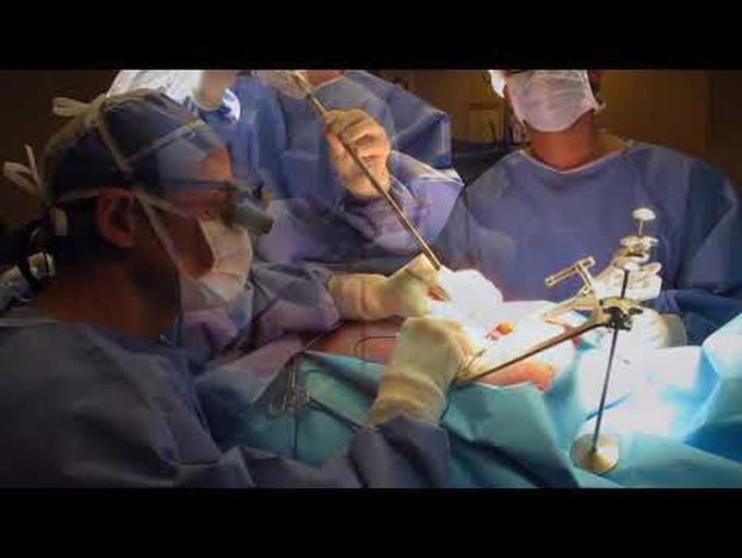 How to Perform a MIDCAB Procedure Step-by-Step in Single Vessel Disease