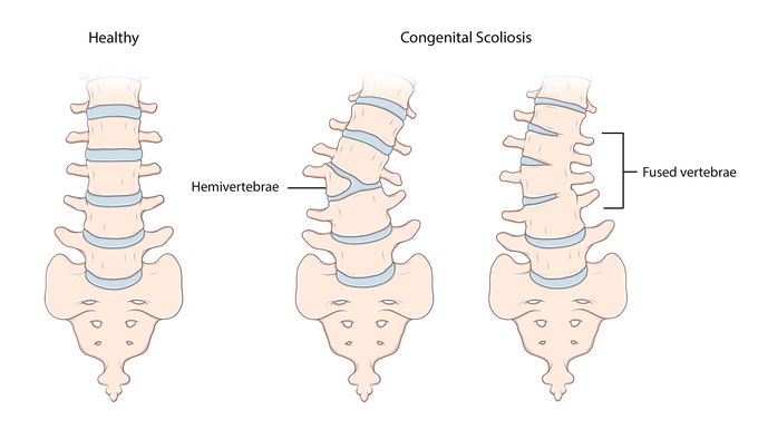 Congenital Scoliosis