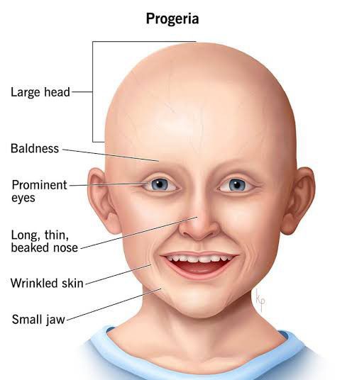 These Are The Symptoms Of Progeria Syndrome Medizzy