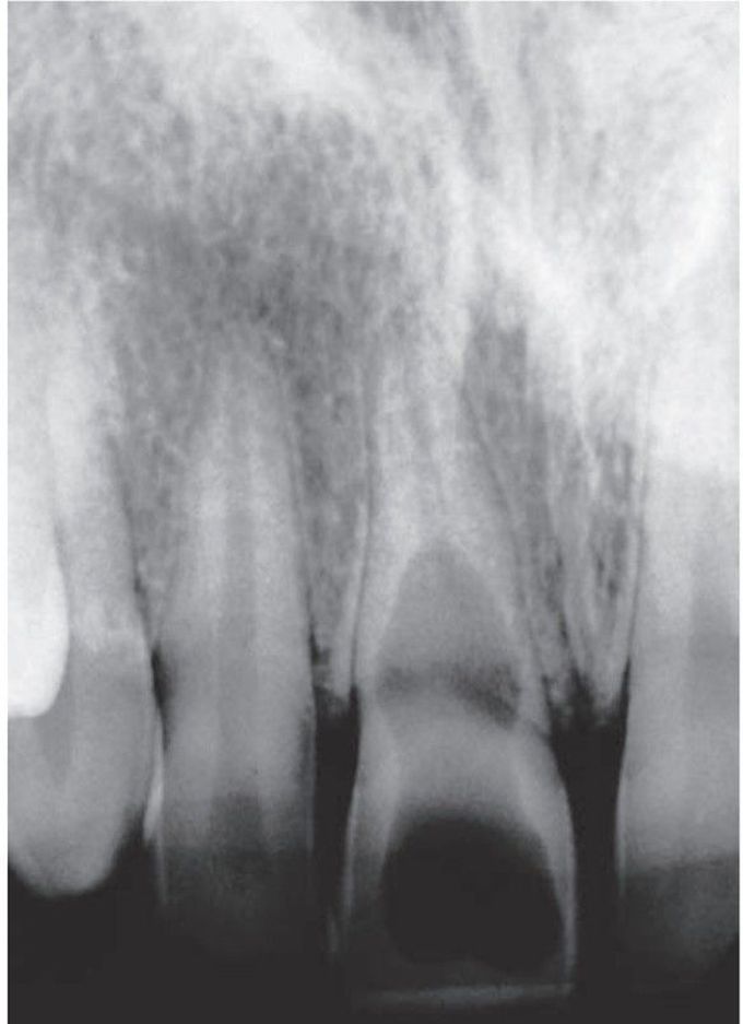 Internal resorption